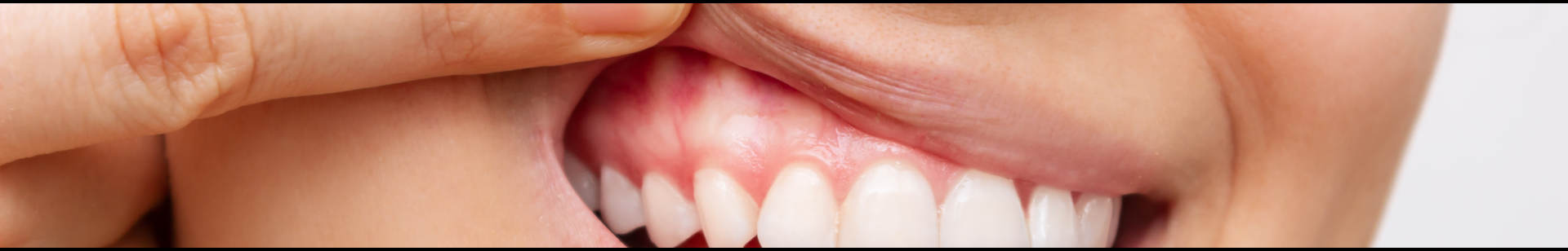 Inflammation gingivale